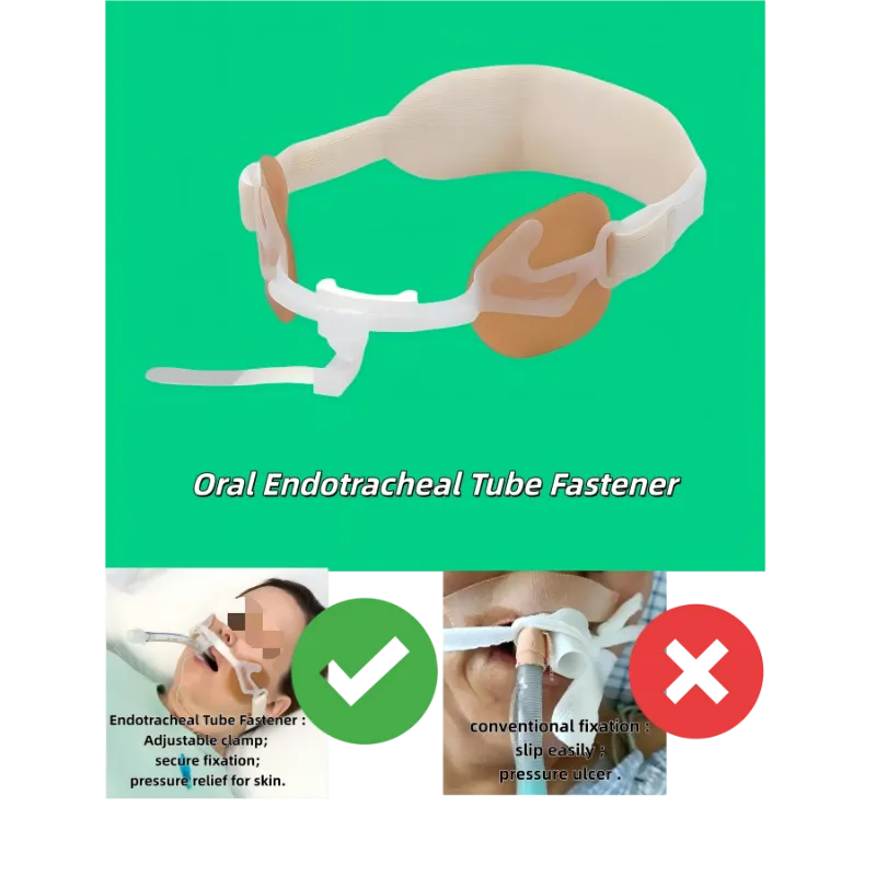 Endotrachealtubus-Befestigung